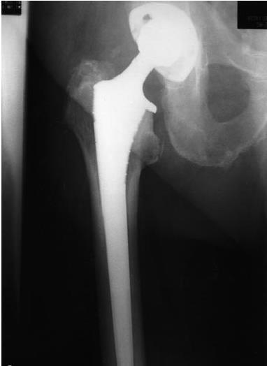 Total Hip Joint Replacement 50,000 hip