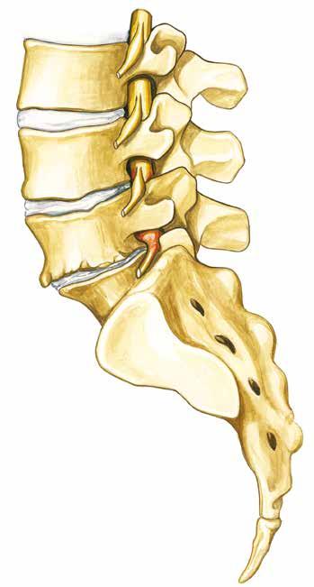 Anatomia kręgosłupa Choroba zwyrodnieniowa krążka międzykręgowego Wraz z wiekiem krążki międzykręgowe tracą są elastyczność i zachodzą w nich naturalne zmiany