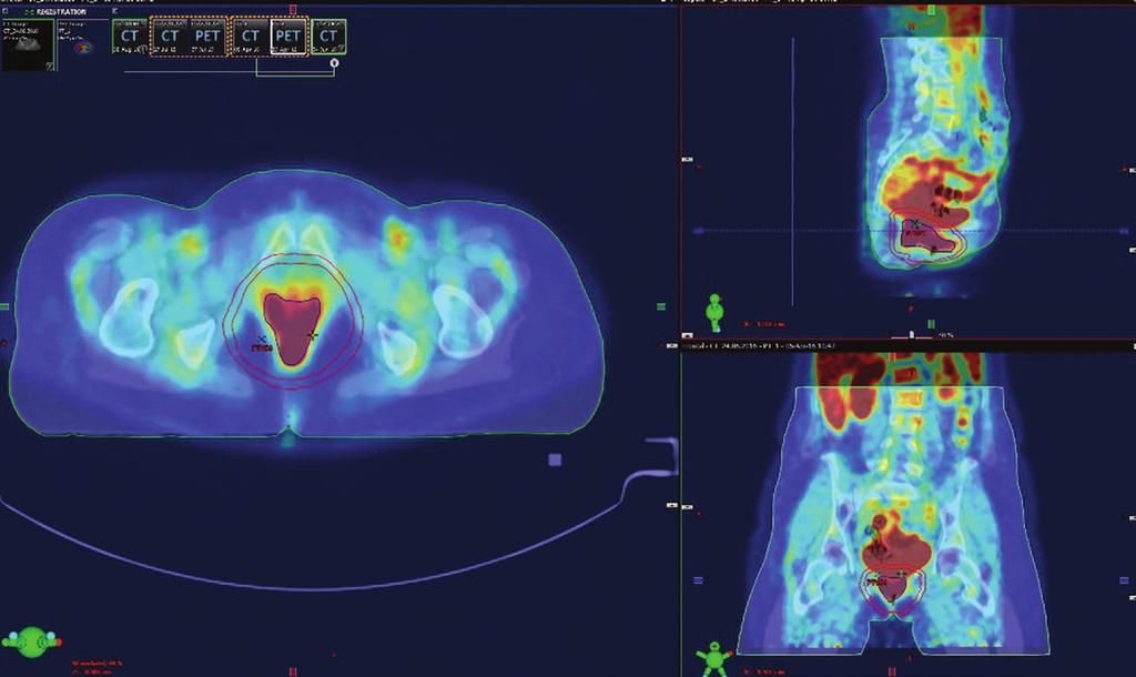 Fuzja PET-CT planowanie leczenia nawrotu w pochwie u chorej z rakiem