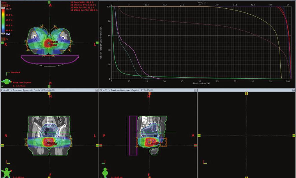 Marta Biedka Ryc. 6 A. Planowanie powtórnej radioterapii IMRT rozkład izodoz, układ wiązek, histogram Fig. 6 A. Planning of the repeated IMRT radiotherapy isodose distribution, beam arrangement, histogram Ryc.