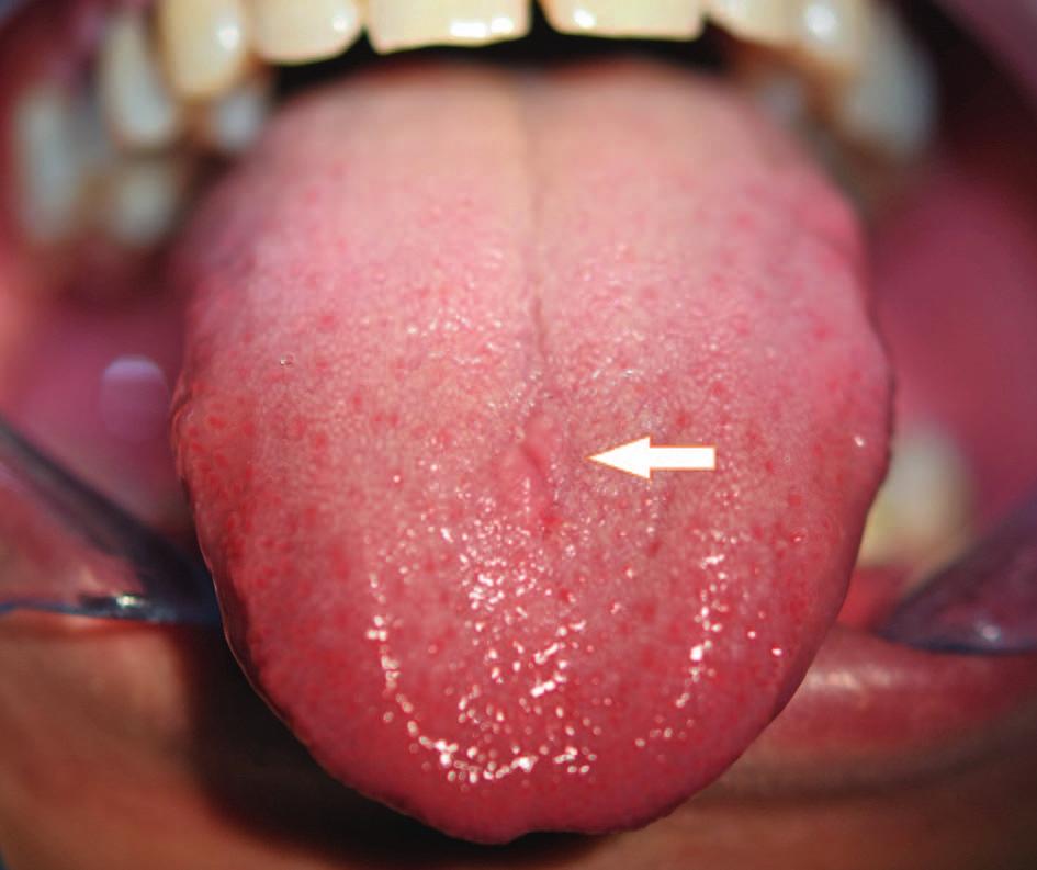 17 Ryc. 17. Pacjent M.W. Ślad po przekłuciu języka (zaznaczony strzałką) Fig. 17. Patient M.W. Tongue piercing scar (indicated by an arrow) zwrócenia na siebie uwagi, ale również samookaleczenia.