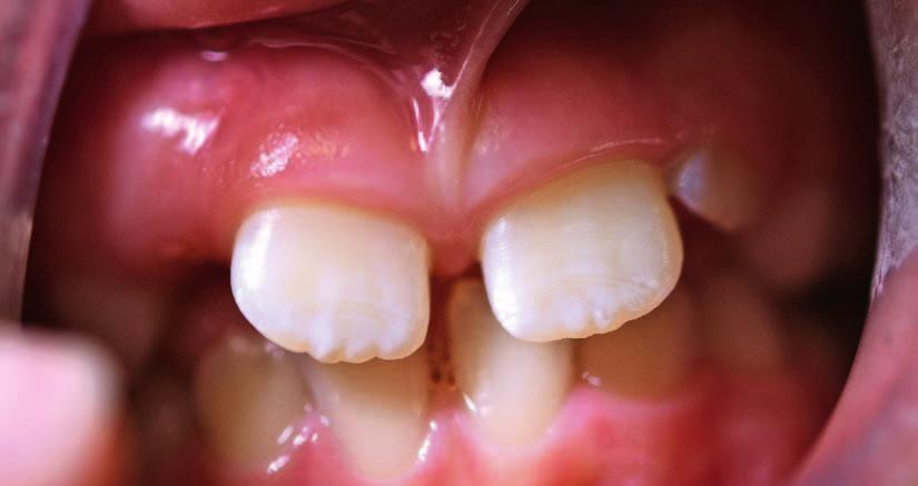 ORTODONCJA W PRAKTYCE 4/2017 1 ryc. archiwum autorki Ryc. 1. Diastema fizjologiczna towarzysząca wymianie zębów siecznych Fig. 1. Physiological diastema accompanying the exchange of incisors od przynależności do grupy wiekowej i nie podlega samoregulacji.