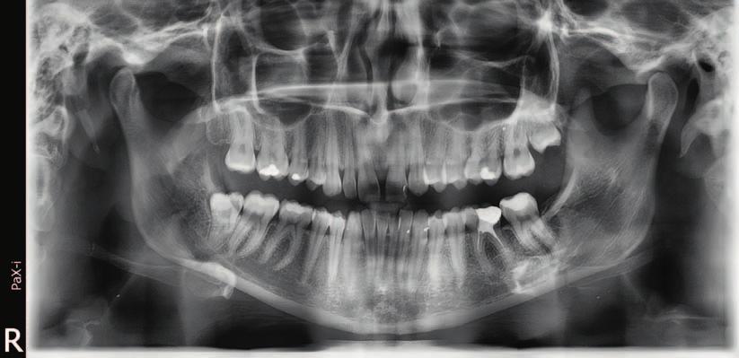 ORTODONCJA W PRAKTYCE 4/2017 6 7 8 Ryc. 6. Pacjentka K.S. Pantomogram potwierdzający brak zawiązka zęba 22 Ryc. 7. Pacjentka K.S. Fotografia wewnątrzustna obrazująca diastemę rzekomą Ryc.