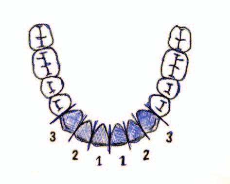 Diastemę zamknęłam całkowicie za pomocą stałego aparatu cienkołukowego, którym wyprowadzition the lateral incisor makes up 62% of the central incisor width, and the
