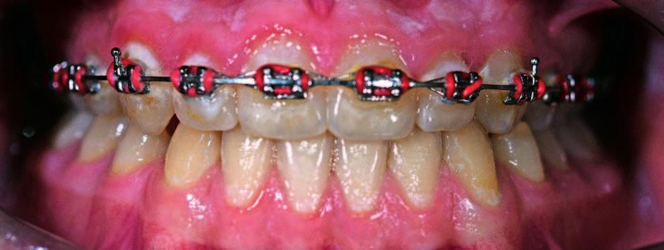 Notably improved gum contour above teeth 32 and 42 after the traumatic occlusion was eliminated łam boczne zęby sieczne ze zgryzu krzyżowego. Na ryc.