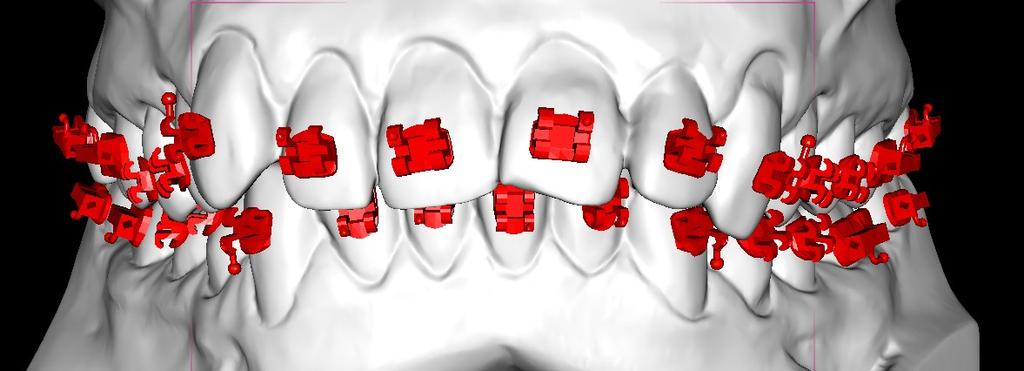 14. Na modelu pojawią się wybrane przez nas zamki. Pozycja zamków na zębach jest wyznaczana według odpowiednich kryteriów dla danego systemu (odległość środka szczeliny od krawędzi siecznej zęba).