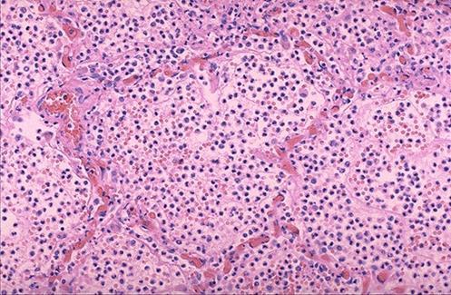 pneumoniae w posiewie plwociny nie przekracza 50% na skuteczność badania bakteriologicznego plwociny wpływa jakość