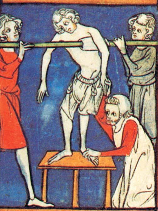 Rycina 2. Wyciąg w bólach dolnego odcinka kręgosłupa wg Rogera z Salerno, ok. 1170 r., cyt. wg 21. Opis anatomiczny nerwu kulszowego przedstawił w 1363 r., francuski lekarz Guy de Chauliac (ok.