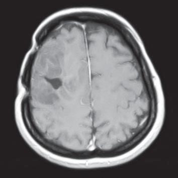 konsultowana oraz leczona onkologicznie. Nie zgłaszała się na kontrole do poradni neurochirurgicznej. W badaniu NMR wykonanym w lutym 2009 zdiagnozowano wznowę guza (ryc. 1).