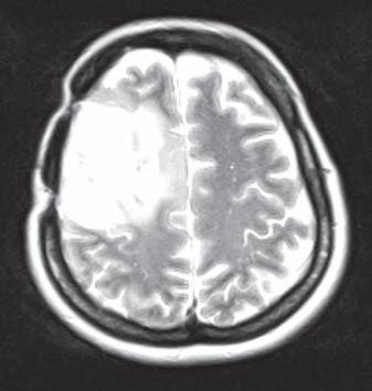 Zalecono poszerzenie diagnostyki o badanie PET-CT celem oceny zakresu wznowy. Badanie PET-CT potwierdzało rozległą wznowę guza, sugerowało również transformację złośliwą (ryc. 2).