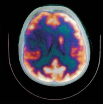 Podczas operacji wykorzystano nóż ultradźwiękowy - CUSA. Zakres resekcji guza zaznaczono na rycinie czarną linią na badaniach NMR i PET-CT (ryc. 3).