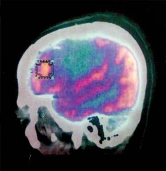 Z obszarów resekcji oznaczonych numerami 1 i 4 uzyskano rozpoznanie histopatologiczne: glioma mixtum (oligo-astrocytoma) II o biol. złośliwości wg WHO (ryc. 4).