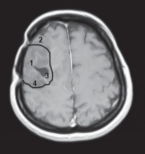 Rycina 3. E.K. lat 46. Zakres resekcji guza. Rycina 4. Glioma mixtum (oligo-astrocytoma) II o biologicznej złośliwości wg WHO, obraz mikroskopowy.
