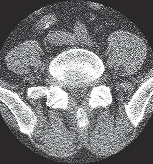 Dopuszczalnym jest diagnozowanie i leczenie dyskopatii lędźwiowej na podstawie badań KT, ale ich sposób wykonania musi pozwalać na rozróżnienie tarczki od