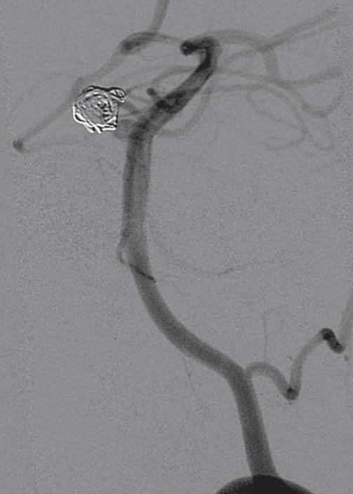 C A B Rycina 1c. Angiograficzne badanie kontrolne po embolizacji za pomocą spiral platynowych - niecałkowite wypełnienie tętniaka, wypełniająca się nieco szyja tętniaka. w obrębie stentu.