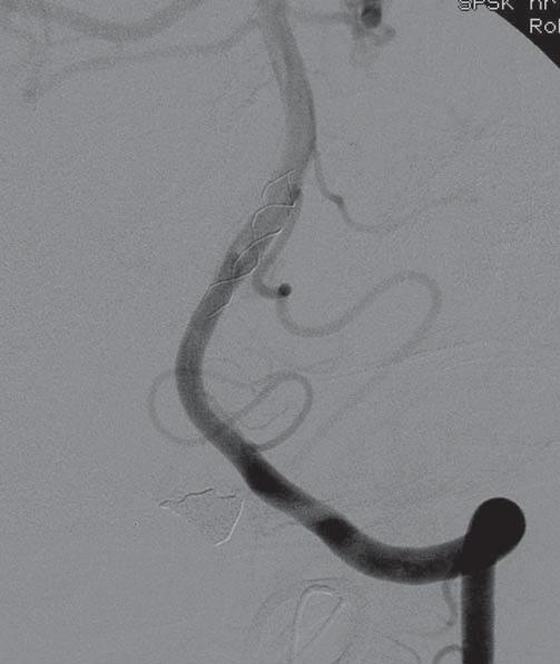 C D Rycina 2d. Angiografia kontrolna po zabiegu implantacji drugiego stentu Leo 2,5x12 - techniką stent w stent. Rycina 2c. Angiografia kontrolna po implantacji stentu Leo 2,5x18.