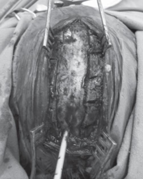 Zabieg wykonywano z pośrodkowego cięcia skóry. Wycinano pasek kości ciemieniowych szerokości około 1,5-2cm nad zatoką strzałkową, od przedniego do tylnego ciemienia (1, 7) (ryc. 1).