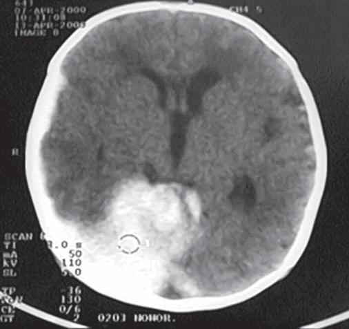 while physiologic delivery in primigravida mothers. There were no relations between termination of the gravidity, birth body mass and intracranial bleeding.