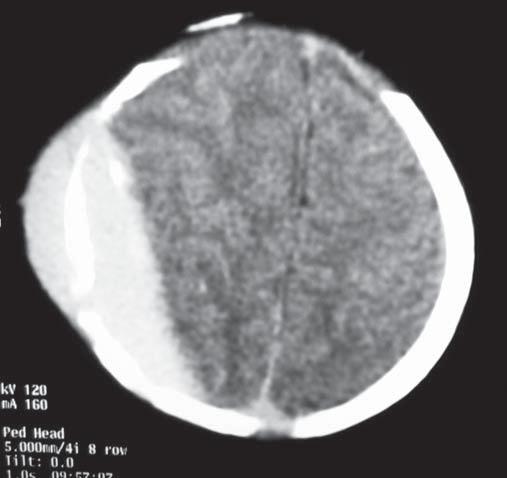 Symptoms of intracranial bleeding developed in nine neonates between first and therd day of postnatal live, in one child two weeks after. They did not localised the site of intracranial bleeding.
