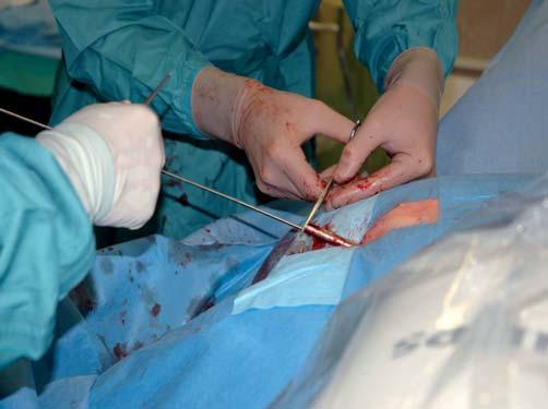 W ostatnim etapie operacji usuwamy dilatator, przez który była wprowadzana śruba stabilizująca, a pole