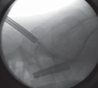 Po kontrolnej fluoroskopii, usuwamy trokar, który zastąpiony zostaje drutem