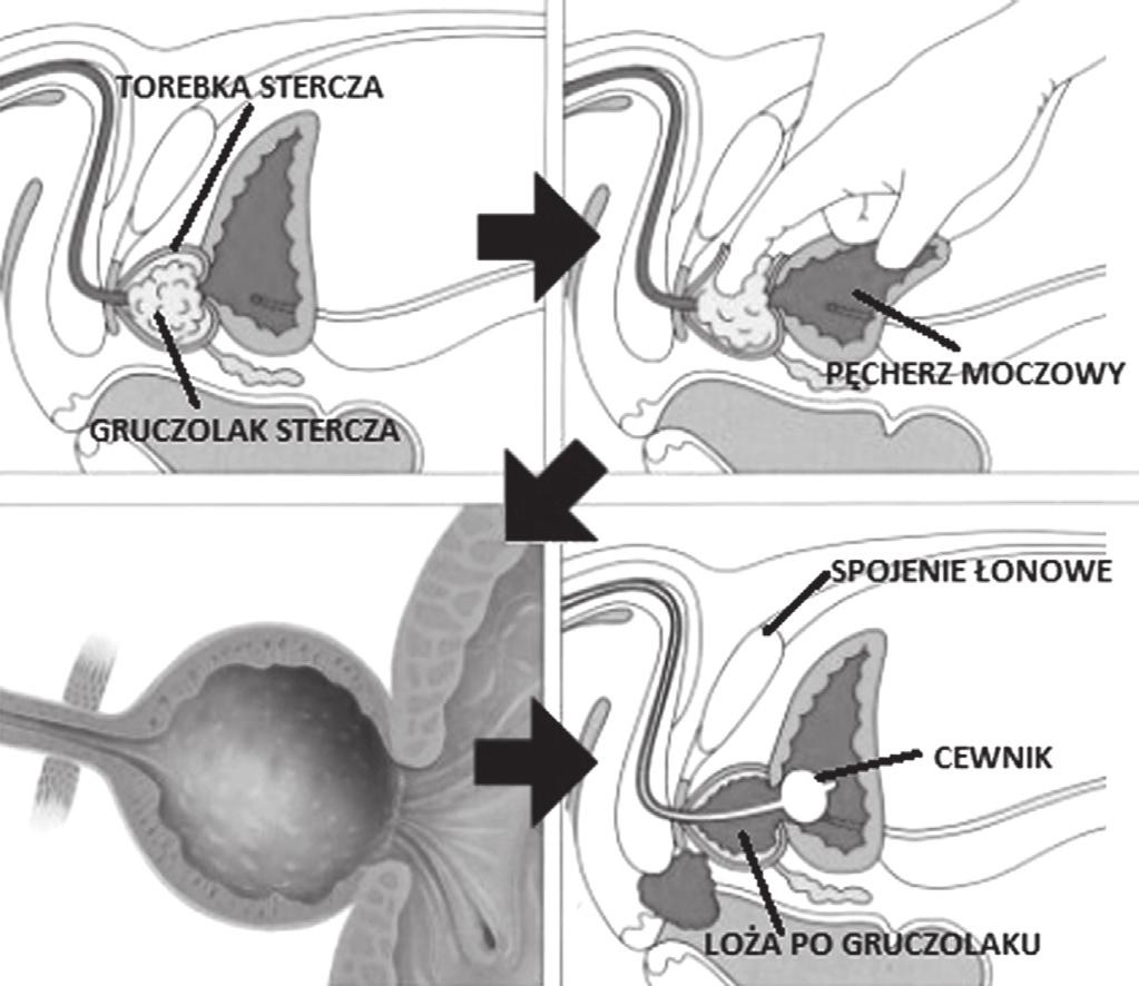 gruczolak (adenomektomia przezsterczowa), lub, alternatywnie, wykonywane jest nacięcie na przedniej powierzchni pęcherza moczowego i następnie tą drogą usuwana jest wewnętrzna część gruczołu