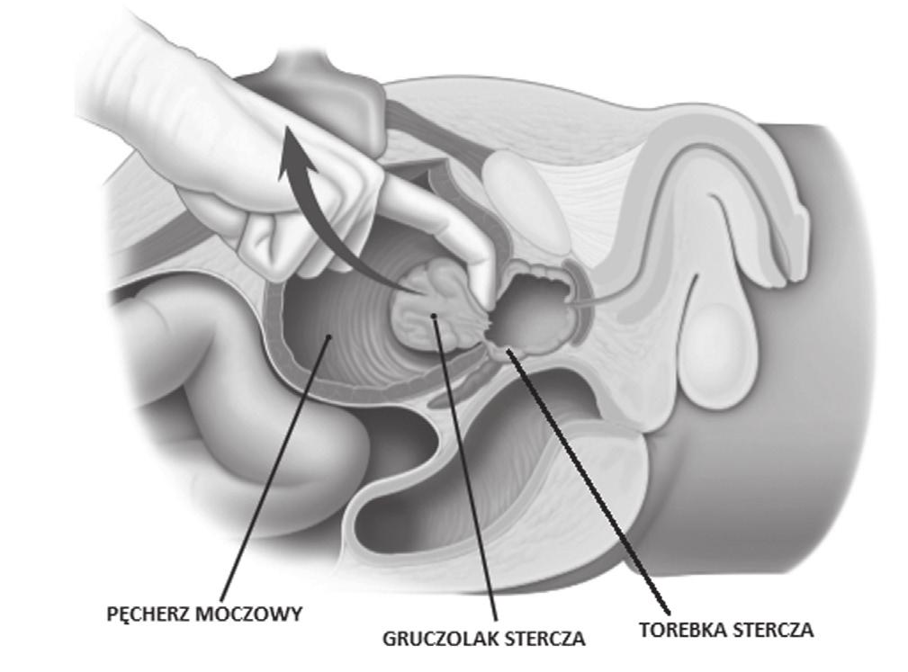 O wyborze techniki operacyjnej decydują specyficzne warunki anatomiczne, stopień powiększenia prostaty, preferencje operatora oraz ewentualne współistnienie kamicy pęcherza moczowego.