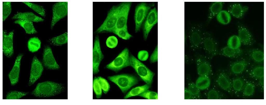 [ 104 ] Podstawy immunologii dla reumatologów mięśni i stawów bez nadżerek oraz zajęcie narządów wewnętrznych, zwłaszcza śródmiąższowa choroba płuc (głównie anty-pl-7).