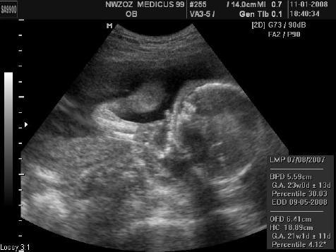 Ultrasonografia (USG) Ultrasonografia wykorzystuje zjawiska falowe dźwięku na