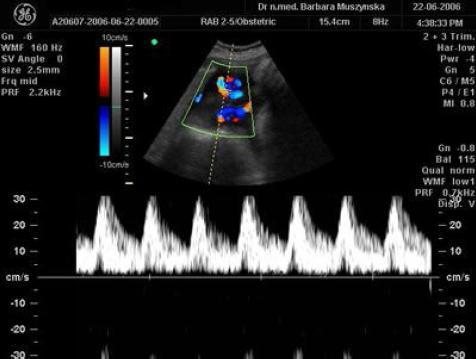 USG dopplerowskie Diagnostyka układu krążenia ocena przepływu
