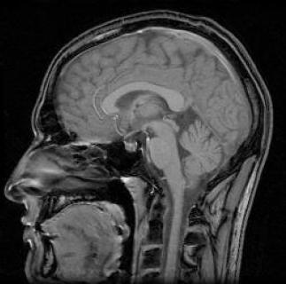 Obrazowanie rezonansu magnetycznego (MRI) Wykorzystuje jądrowy rezonans magnetyczny jąder wodoru zawartych w wodzie (tkanki żywe) Oddziaływanie bardzo silnym