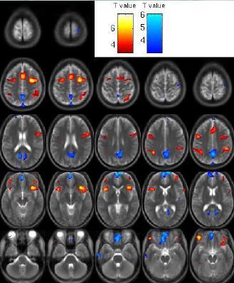 fmri Funkcjonalny rezonans