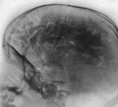 Pneumoencefalografia (historycznie) Prześwietlenia RTG komór mózgowia Gaz dobrze kontrastuje wnętrze czaszki: wprowadzano przez nakłucie do kanału rdzenia kręgowego tlen lub
