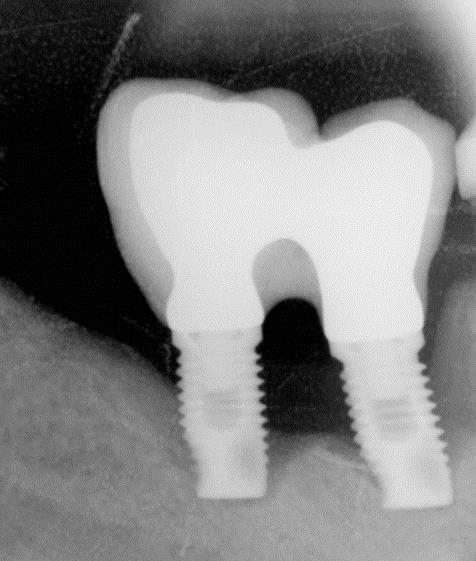 Duran-Cantolla J, Alkhraisat MH: Frequency of Prosthetic