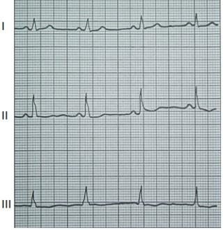 Na którym z zapisów EKG