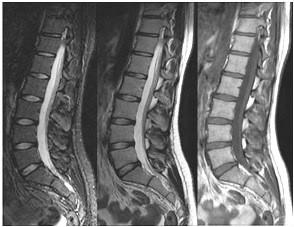 Zaznaczona strzałką struktura anatomiczna na obrazie rezonansu magnetycznego to A. sierp mózgu. B. szyszynka. C. móżdżek. D. komora. Zadanie 25.