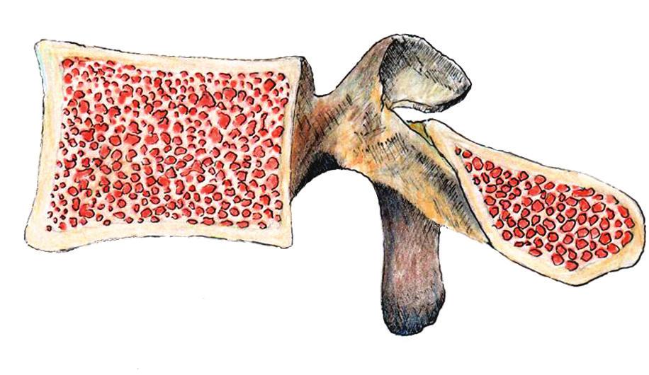teoporotic fractures performed without general anaesthesia is a safe solution dedicated to elderly patients.