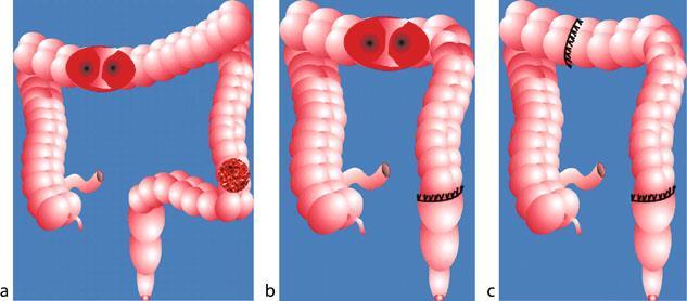 Three-staged procedure 1. Kolostomia 2. Resekcja zmiany i zespolenie 3.