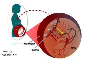 Matka-łożysko-płod: kompleksowa odpowiedź na infekcje FIRS fetal inflammatory response syndrome, stan zapalny płodu charakteryzujący się dużym stężeniem IL-1, IL-6, IL-8, TNF-a (IFN-g, MCP-1).