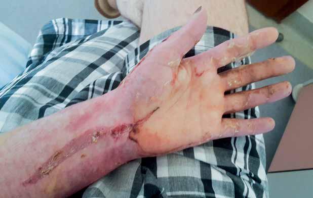 Zdj. 8B. Ręka lwa, strona dłoniowa, dziwiąta doba po zabigu przszczpu skóry Taki postępowani traputyczn umożliwia pacjntowi uzyskani satysfakcjonującgo zakrsu ruchomości w stawach ręki.