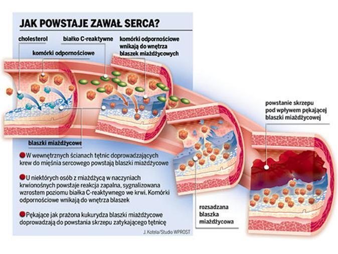 Przeszczepienie serca cukrzyca,