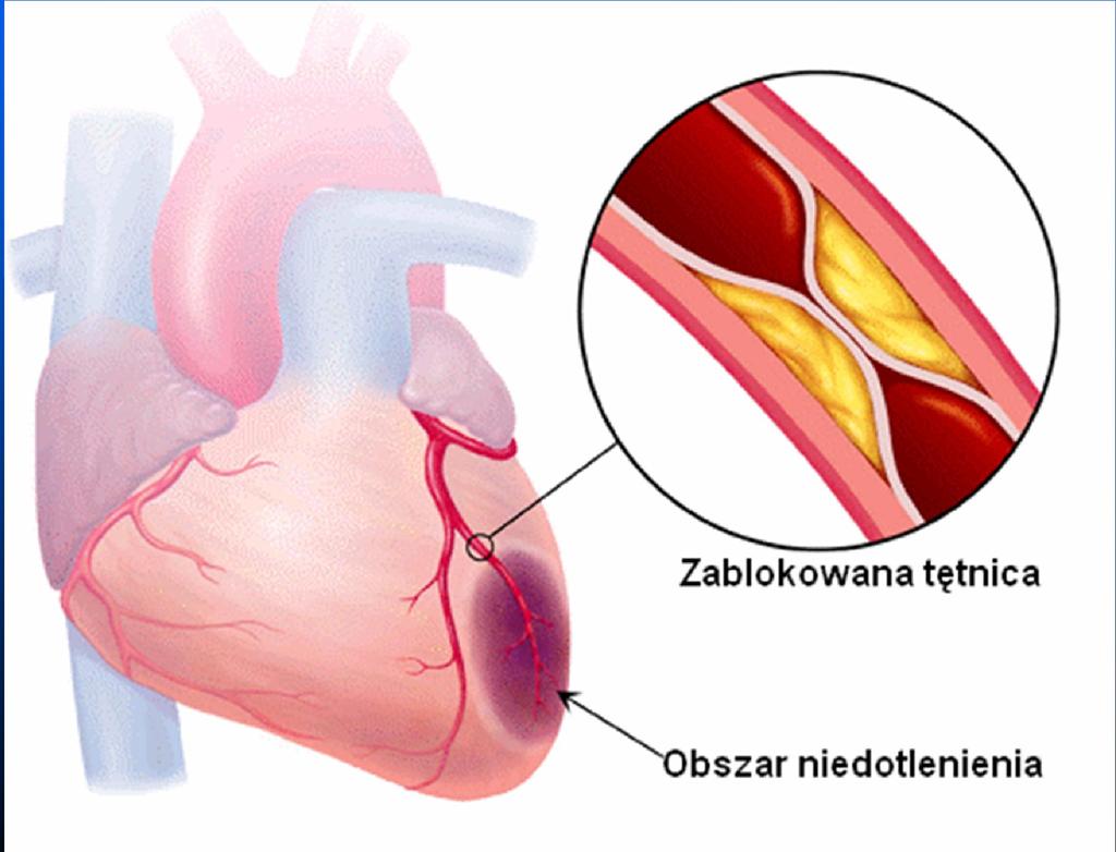 Przeszczepienie serca Najczęstszym