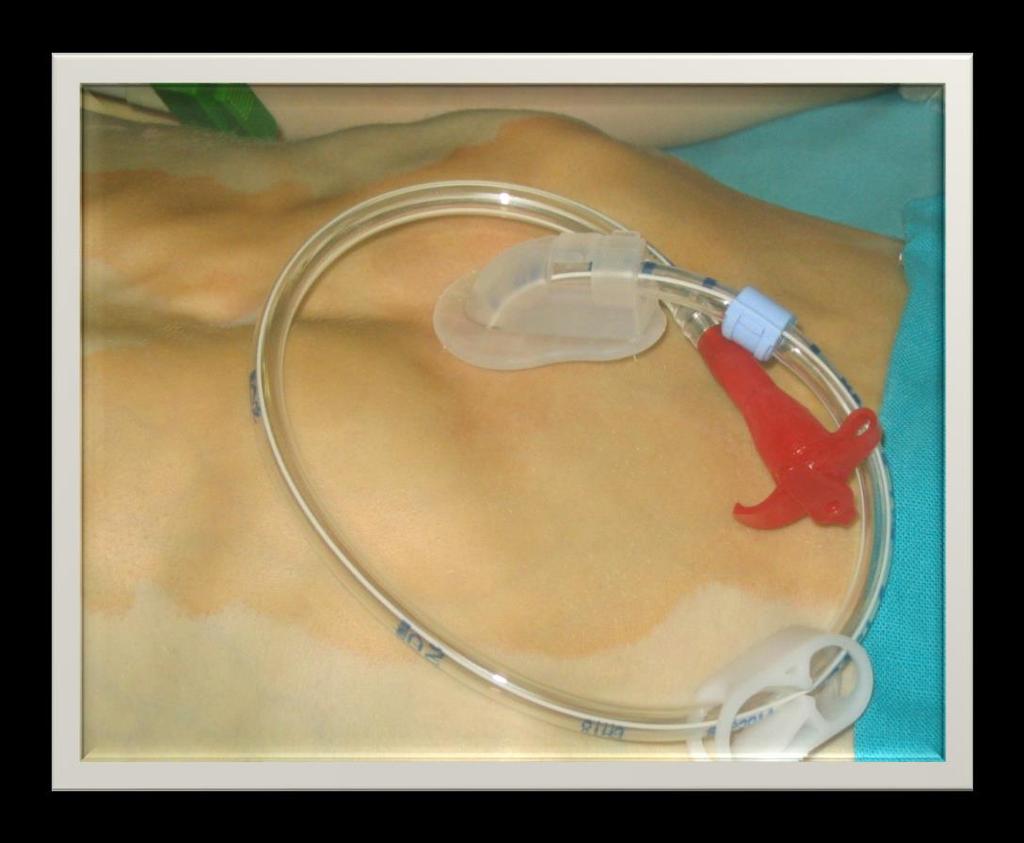 Przezskórna endoskopowa gastrostomia