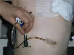 Przezskórna endoskopowa gastrostomia wskazania paliatywne odbarczenie