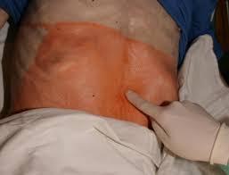 Przezskórna gastrostomia endoskopowa ( PEG) Zabieg prosty,