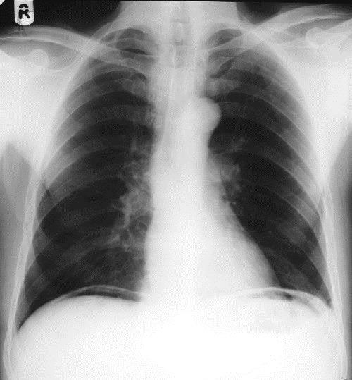 Pneumoperitoneum około 50%