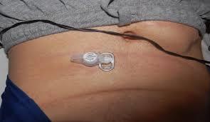 Gastrostomia