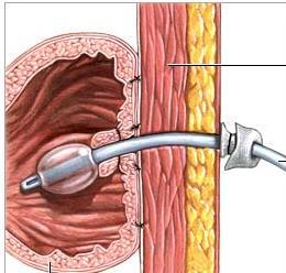 Gastrostomia - Żołądkowa przetoka odżywcza Przezskórna gastrostomia endoskopowa ( PEG) Gastrostomia wprowadzana pod