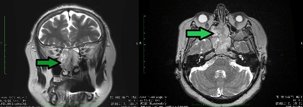W związku z obrazem cytologicznym całkowicie niebudzącym wątpliwości co do łagodnego charakteru zmian w pierwszym etapie leczenia wykonywano u tych chorych operację oszczędzającą.