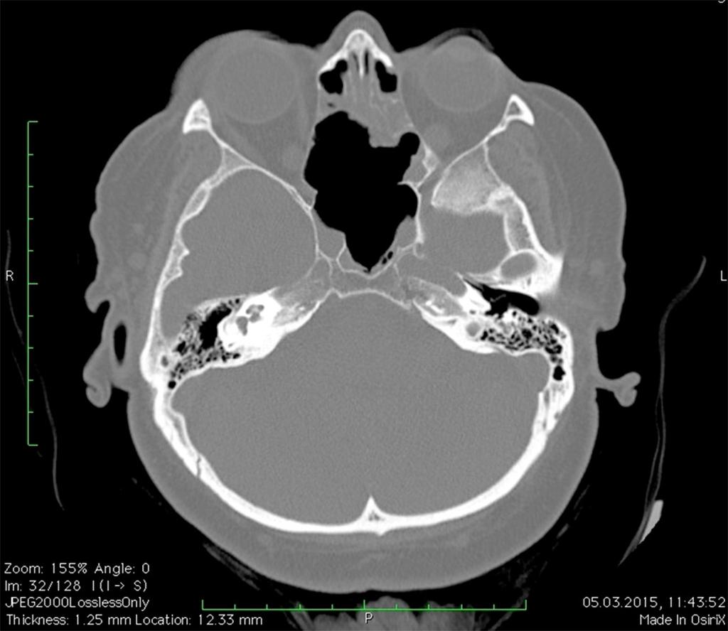 160 Otorynolaryngologia 2017, 16(4): 156-163 Ryc. 4. Tomografia komputerowa zatok obocznych nosa. Projekcja osiowa.
